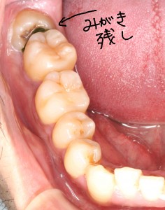 生えかけの親知らず 抜歯したほうが良い理由 大阪 北浜の歯医者さん 筒井歯科ブログ