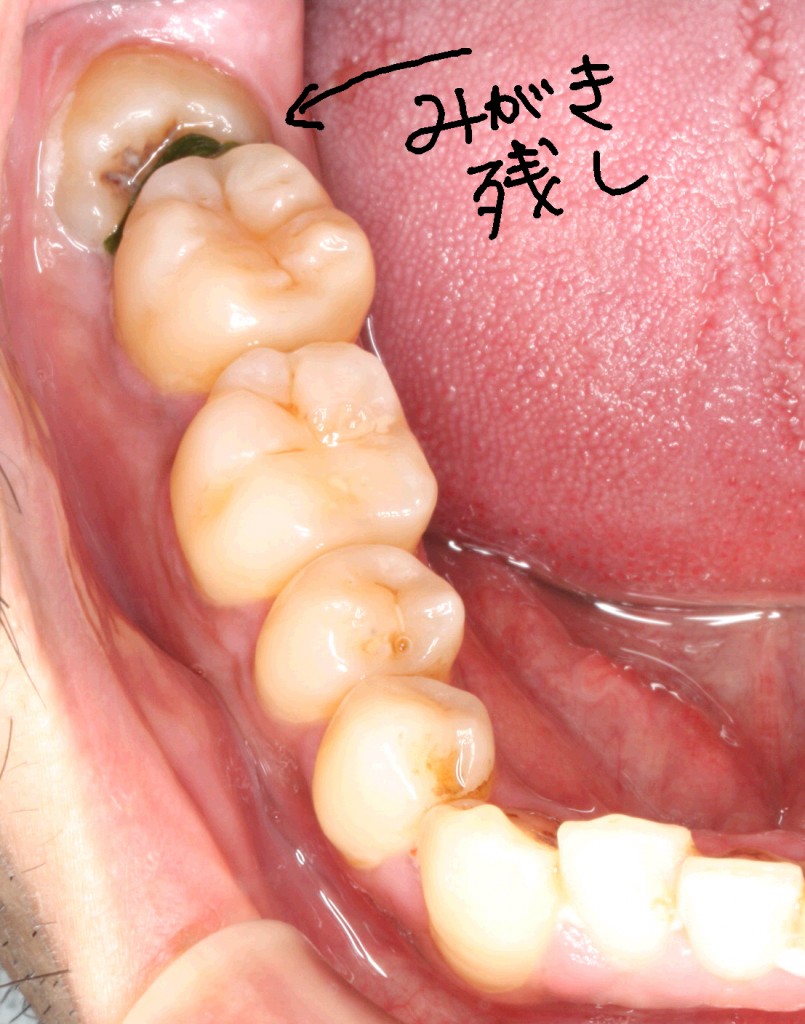 親知らず 抜歯 後 上 の 歯 が 痛い