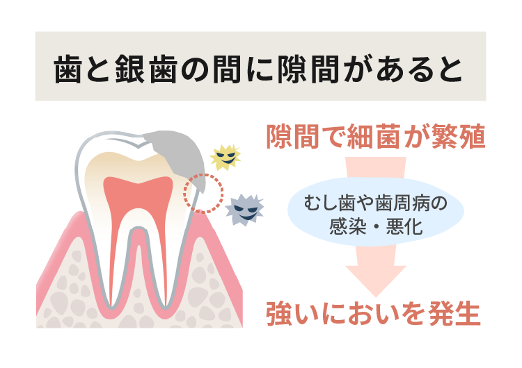 歯と銀歯の間に隙間があると