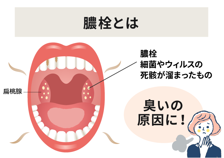 膿栓、臭い玉とは