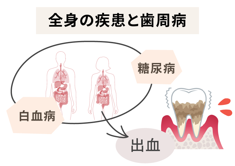 全身疾患と歯周病