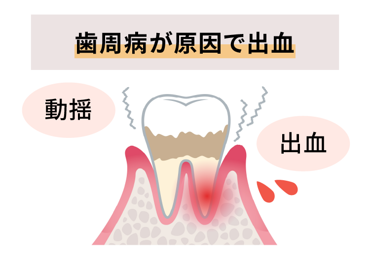 出血の原因は歯周病
