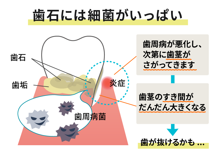 歯石で隙間がだんだん大きくなる