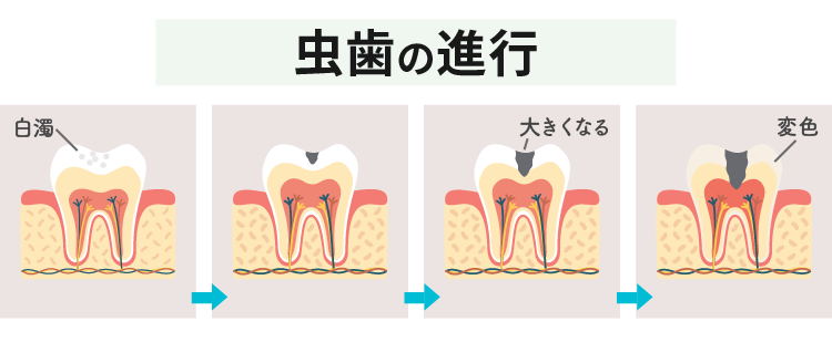 虫歯の進行