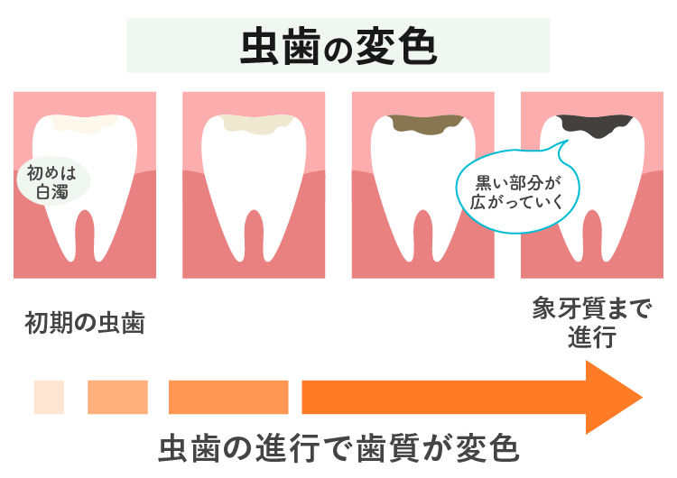 虫歯の変色