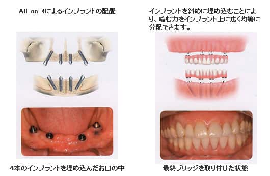 最小4本のインプラントで支えるオールオン4