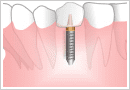 インプラント