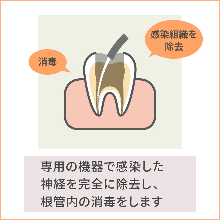 根管治療　神経除去、根管殺菌