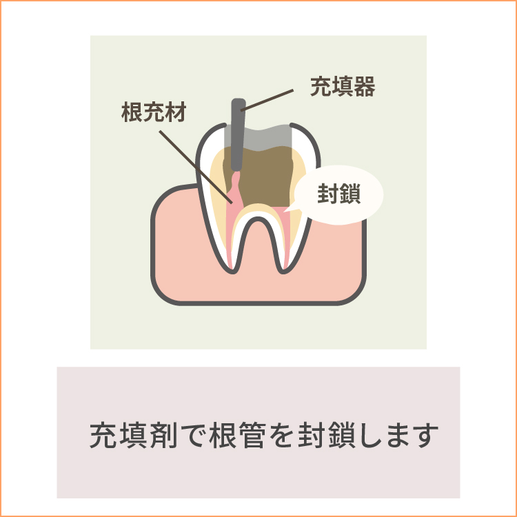 根管を薬剤で封鎖