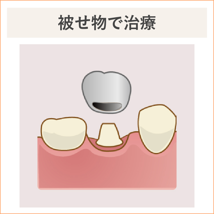 重度の虫歯、被せ物で治療