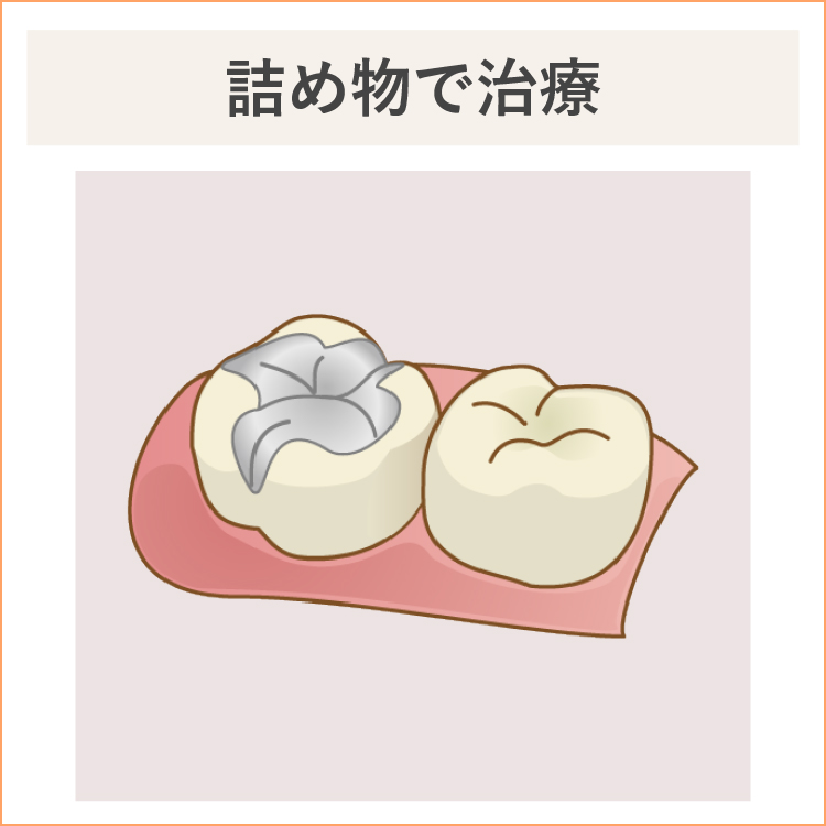 中度の虫歯、詰め物で治療