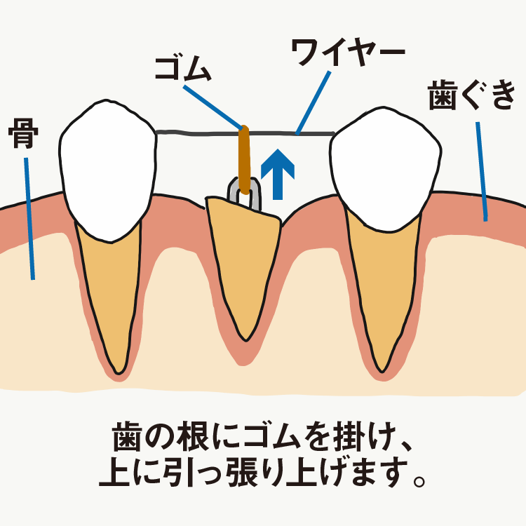 エクストリュージョン