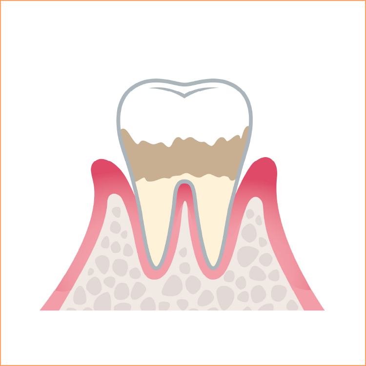 軽度の歯周病