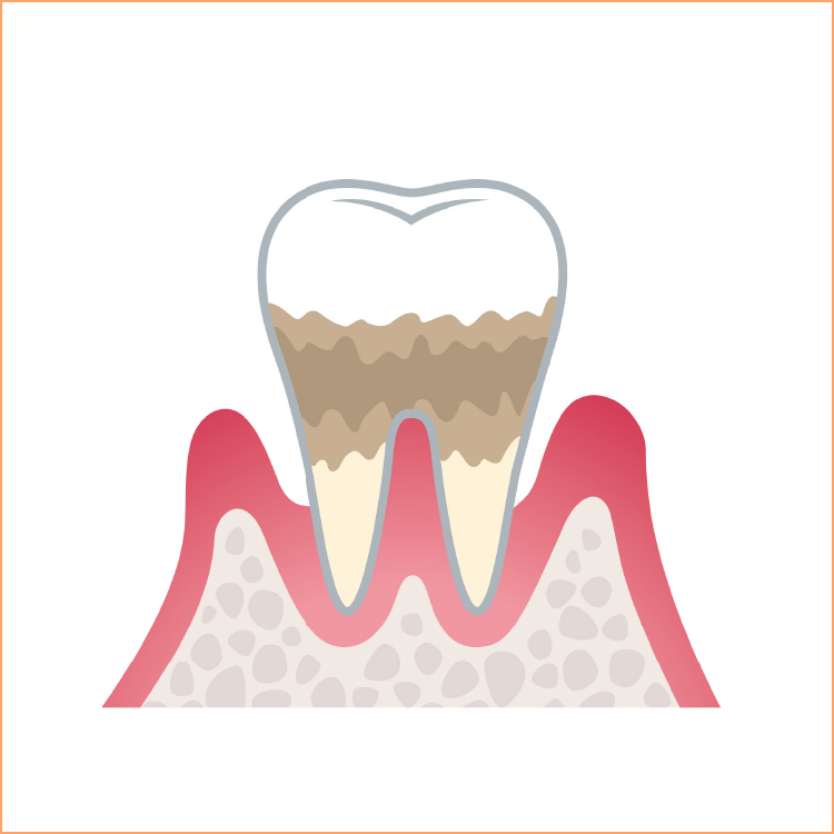 中度の歯周病