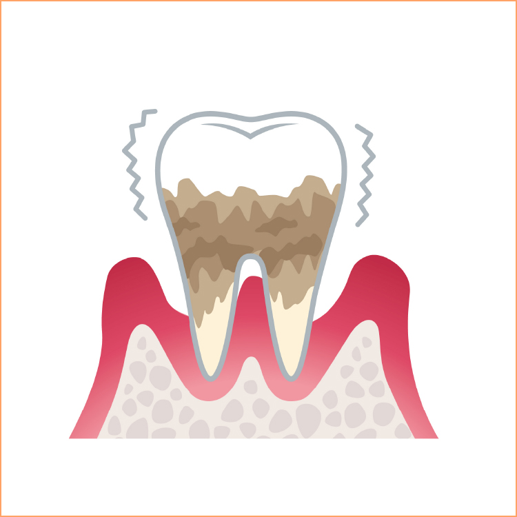 重度の歯周病