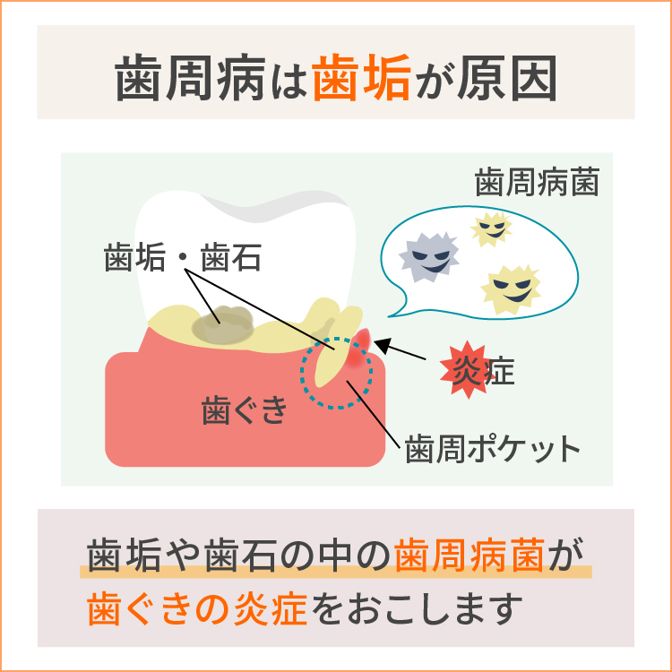 歯周病の原因