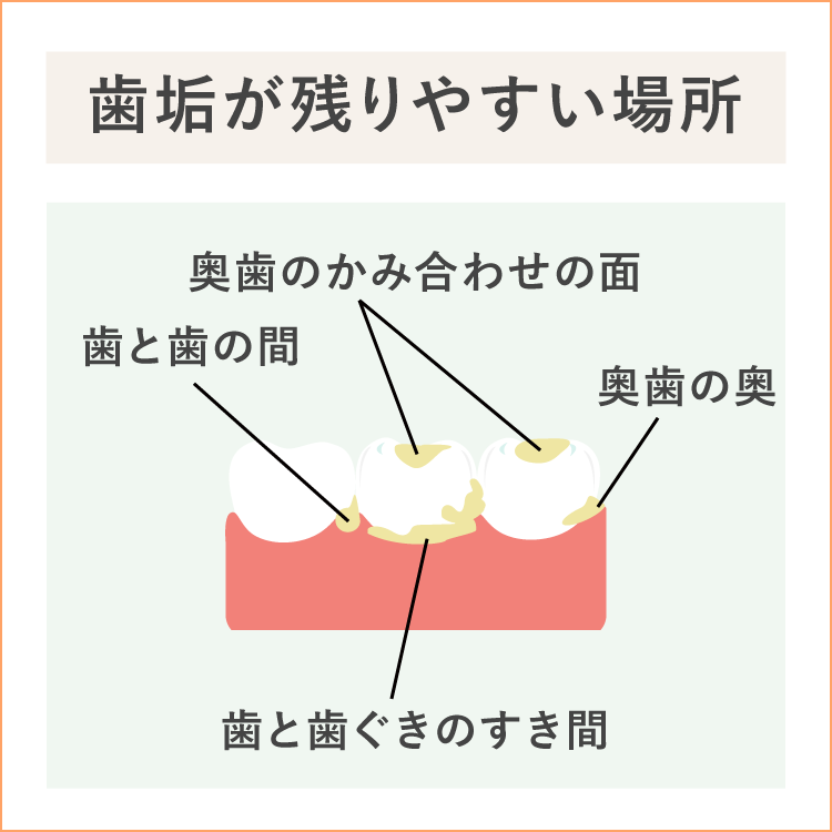 歯垢の残りやすいところ