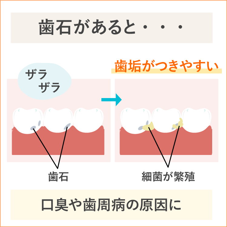 歯石が口臭や歯周病の原因に