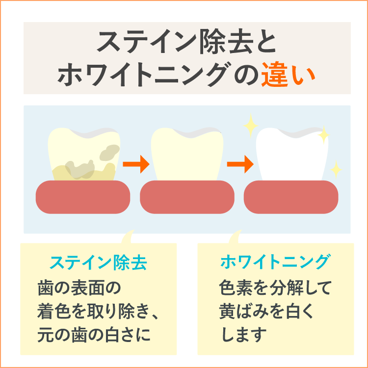 ステイン除去とホワイトニングの違い