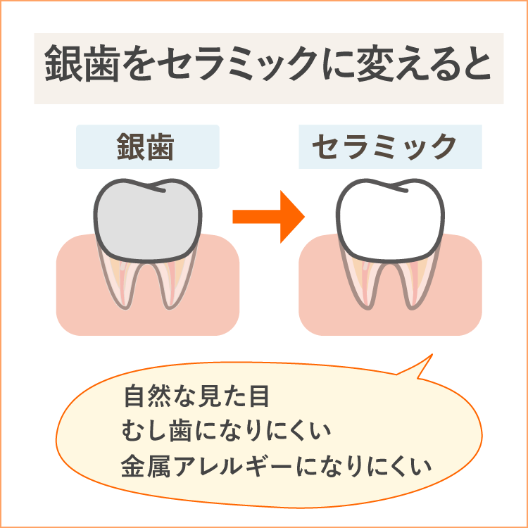 銀歯をセラミックに換えると