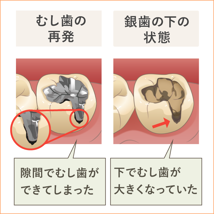 虫歯の再発 二次虫歯