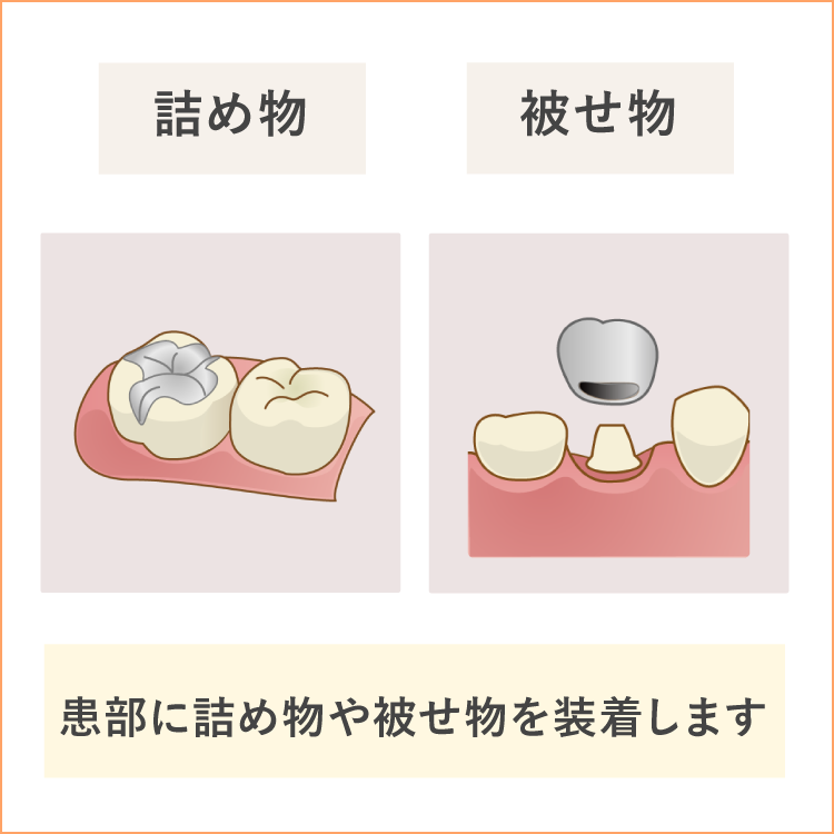 詰め物と被せ物の素材