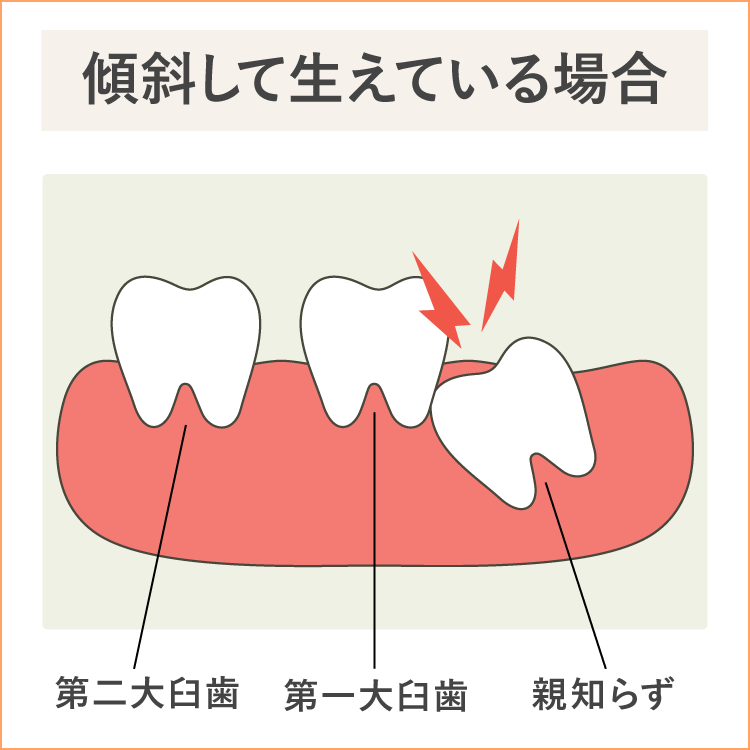 親知らずが原因かも