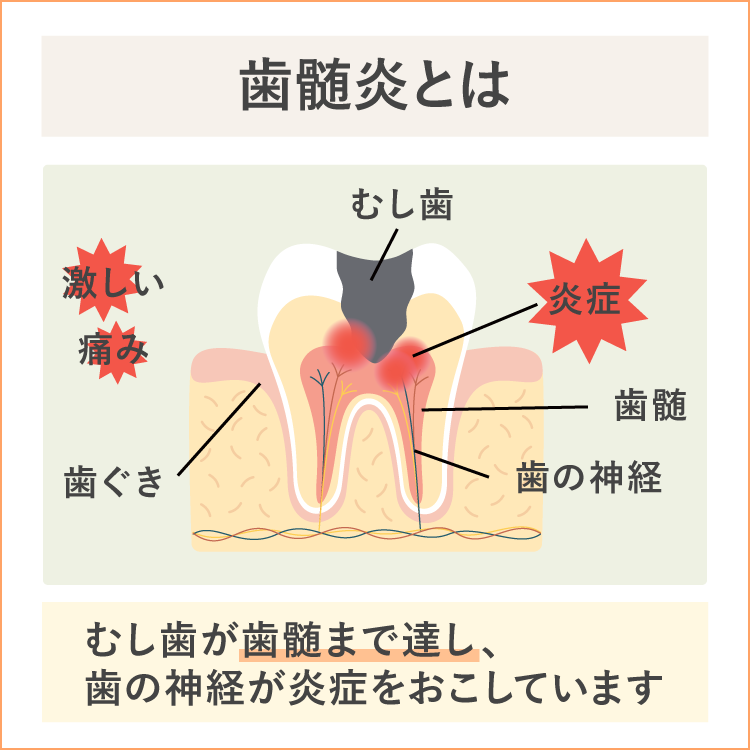 歯髄炎