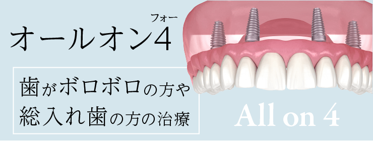 歯がボロボロの方や総入れ歯の方の治療オールオン4インプラント